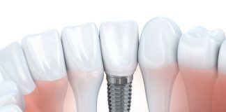 Mini Dental implant